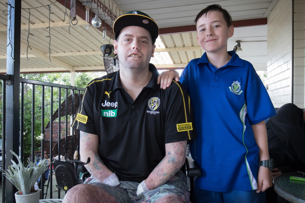 Meningococcal survivor faces his next challenge