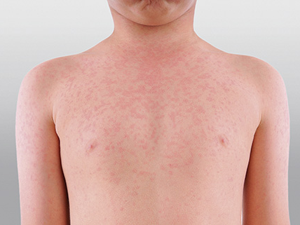 Measles warning issued for all areas of WA